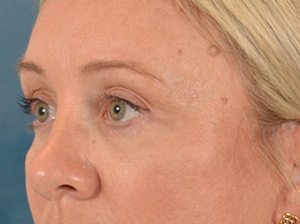 Eyelid Lift Before & After Gallery - Patient 340903 - Image 8
