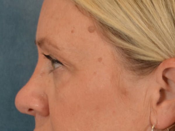 Eyelid Lift Before & After Gallery - Patient 340903 - Image 9
