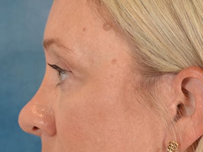 Eyelid Lift Before & After Gallery - Patient 340903 - Image 10