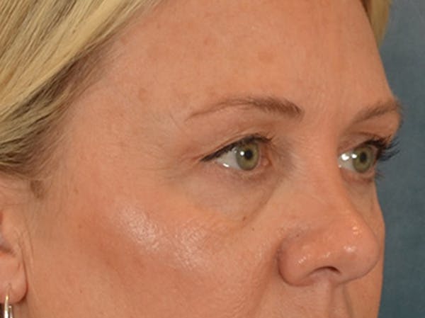 Eyelid Lift Before & After Gallery - Patient 340903 - Image 3