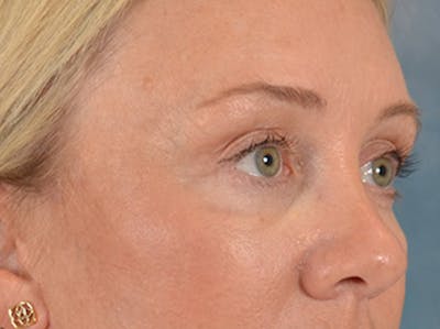 Eyelid Lift Before & After Gallery - Patient 340903 - Image 4