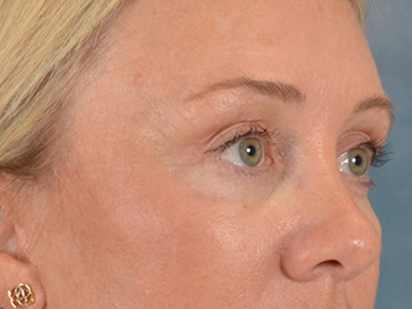 Eyelid Lift Before & After Gallery - Patient 340903 - Image 4