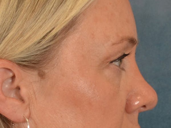 Eyelid Lift Before & After Gallery - Patient 340903 - Image 5