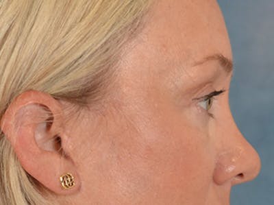 Eyelid Lift Before & After Gallery - Patient 340903 - Image 6