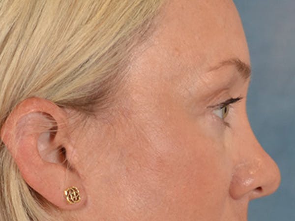 Eyelid Lift Before & After Gallery - Patient 340903 - Image 6