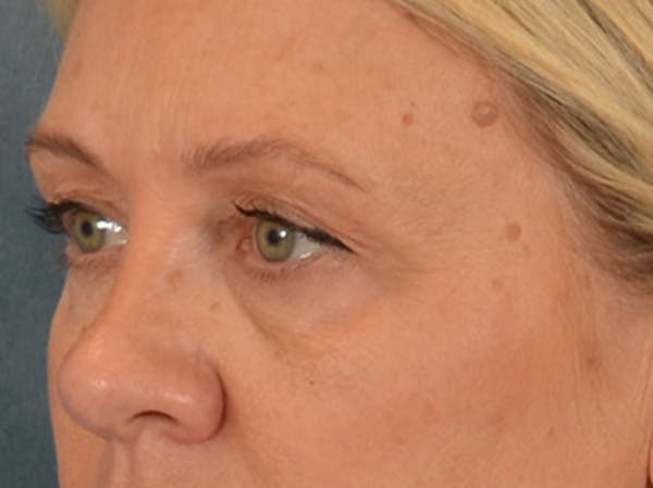 Eyelid Lift Before & After Gallery - Patient 340903 - Image 7
