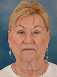 Laser Skin Resurfacing Before & After Gallery - Patient 300194 - Image 1