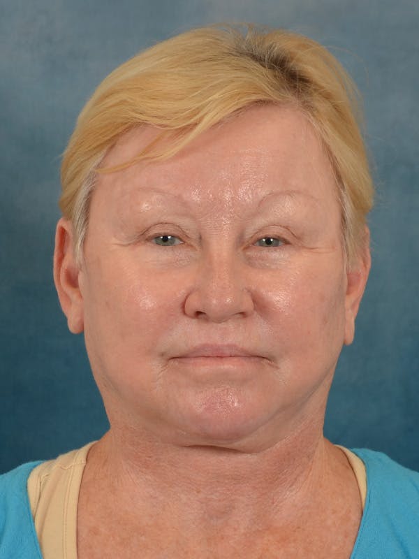 Laser Skin Resurfacing Before & After Gallery - Patient 300194 - Image 2