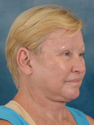 Laser Skin Resurfacing Before & After Gallery - Patient 300194 - Image 8