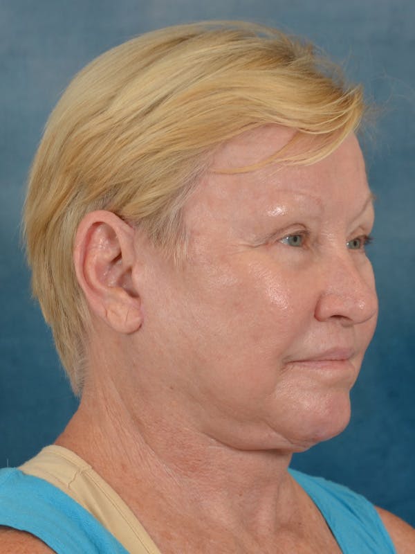 Laser Skin Resurfacing Before & After Gallery - Patient 300194 - Image 8