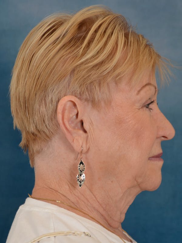 Laser Skin Resurfacing Before & After Gallery - Patient 300194 - Image 9