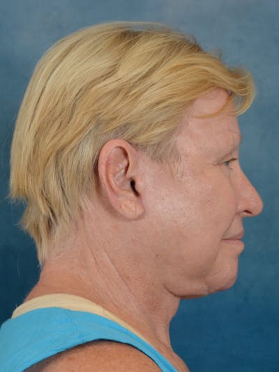 Laser Skin Resurfacing Before & After Gallery - Patient 300194 - Image 10