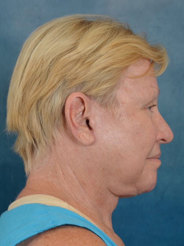 Laser Skin Resurfacing Before & After Gallery - Patient 300194 - Image 10