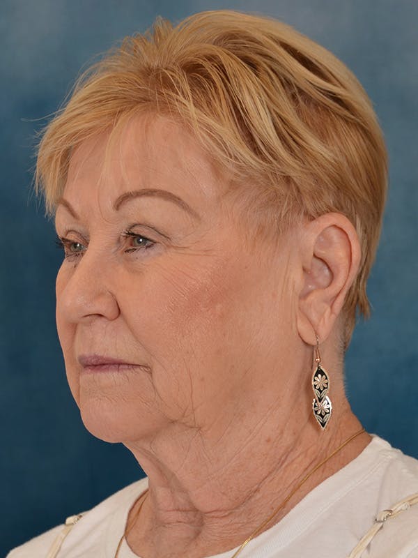 Laser Skin Resurfacing Before & After Gallery - Patient 300194 - Image 3