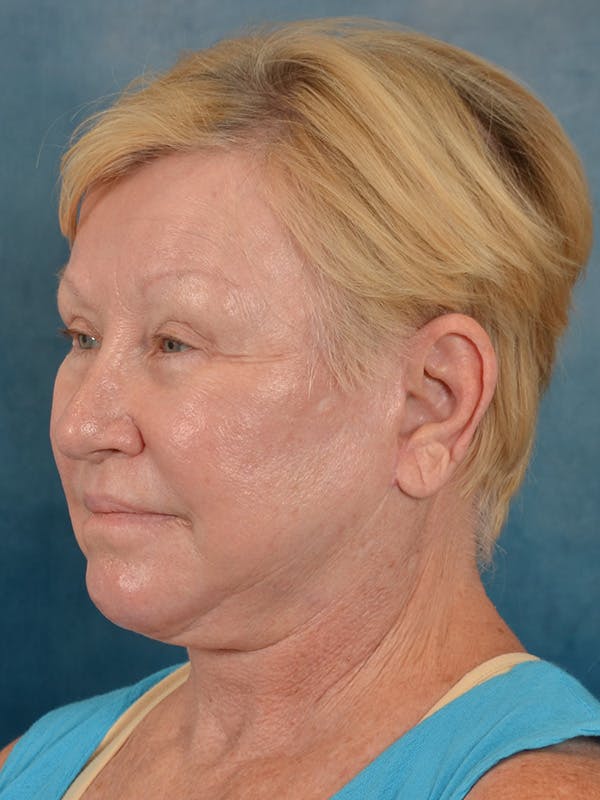 Laser Skin Resurfacing Before & After Gallery - Patient 300194 - Image 4