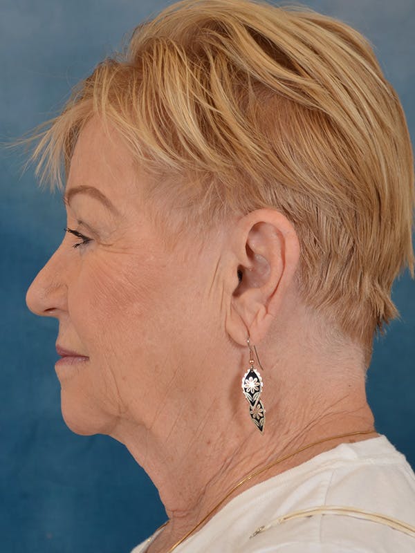 Laser Skin Resurfacing Before & After Gallery - Patient 300194 - Image 5