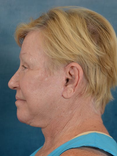 Laser Skin Resurfacing Before & After Gallery - Patient 300194 - Image 6
