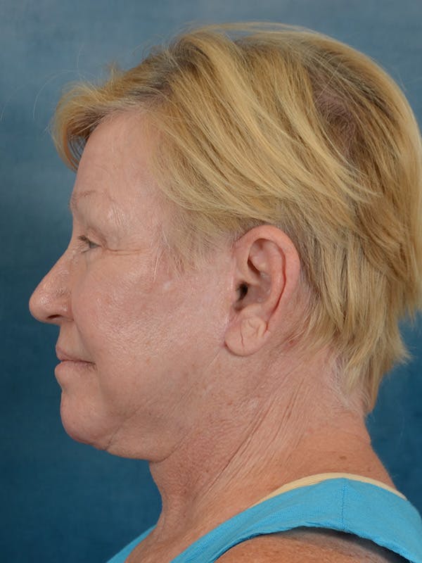 Laser Skin Resurfacing Before & After Gallery - Patient 300194 - Image 6