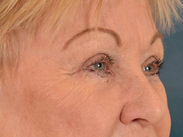 Eyelid Lift Before & After Gallery - Patient 127830 - Image 3