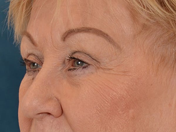Eyelid Lift Before & After Gallery - Patient 127830 - Image 7