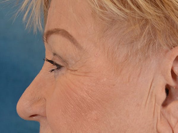 Eyelid Lift Before & After Gallery - Patient 127830 - Image 9