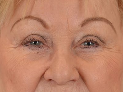 Eyelid Lift Before & After Gallery - Patient 127830 - Image 1