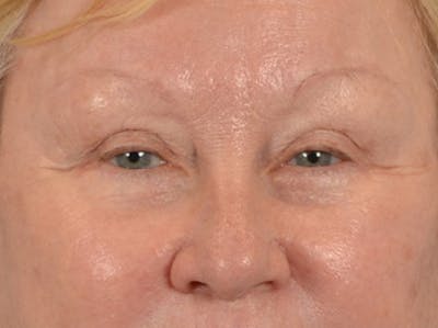 Eyelid Lift Before & After Gallery - Patient 127830 - Image 2