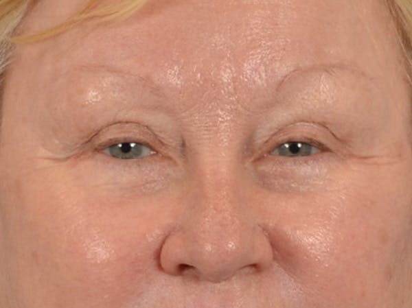 Eyelid Lift Before & After Gallery - Patient 127830 - Image 2