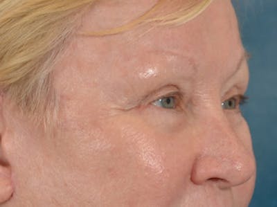 Eyelid Lift Before & After Gallery - Patient 127830 - Image 4