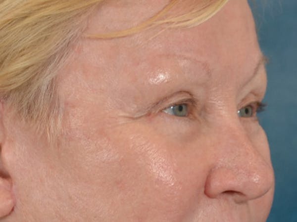 Eyelid Lift Before & After Gallery - Patient 127830 - Image 4