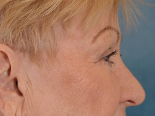 Eyelid Lift Before & After Gallery - Patient 127830 - Image 5