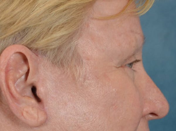 Eyelid Lift Before & After Gallery - Patient 127830 - Image 6