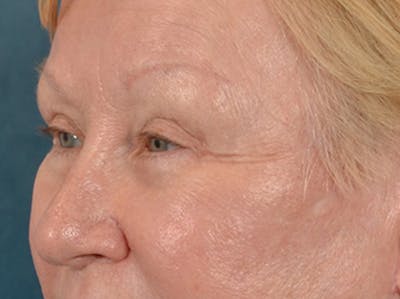 Eyelid Lift Before & After Gallery - Patient 127830 - Image 8