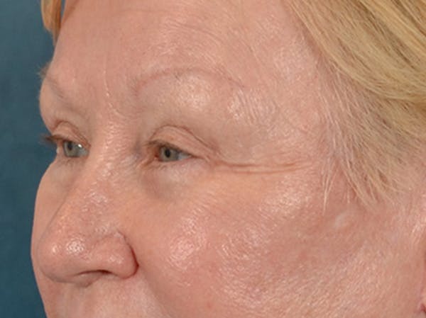 Eyelid Lift Before & After Gallery - Patient 127830 - Image 8