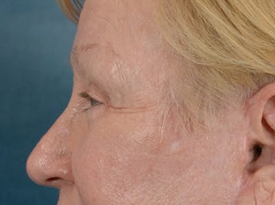 Eyelid Lift Before & After Gallery - Patient 127830 - Image 10