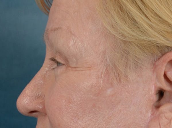 Eyelid Lift Before & After Gallery - Patient 127830 - Image 10