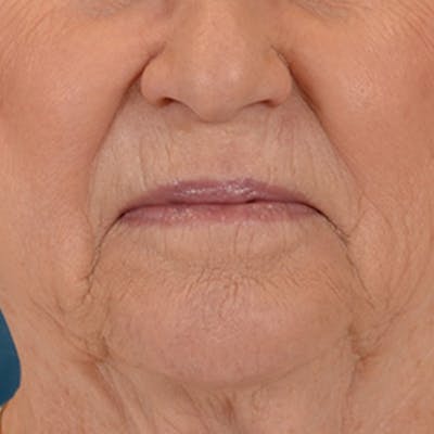 Lip Lift Before & After Gallery - Patient 390400 - Image 1