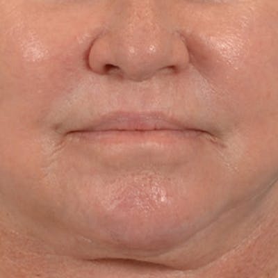Lip Lift Before & After Gallery - Patient 390400 - Image 2