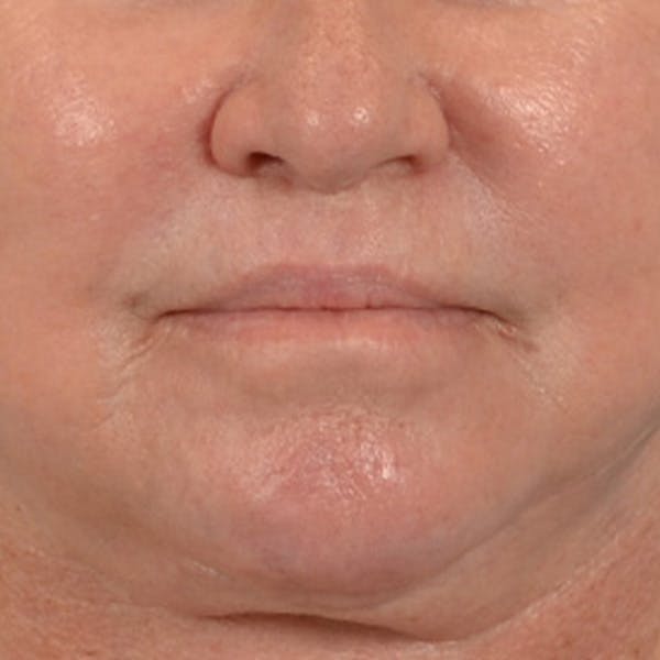 Lip Lift Before & After Gallery - Patient 390400 - Image 2