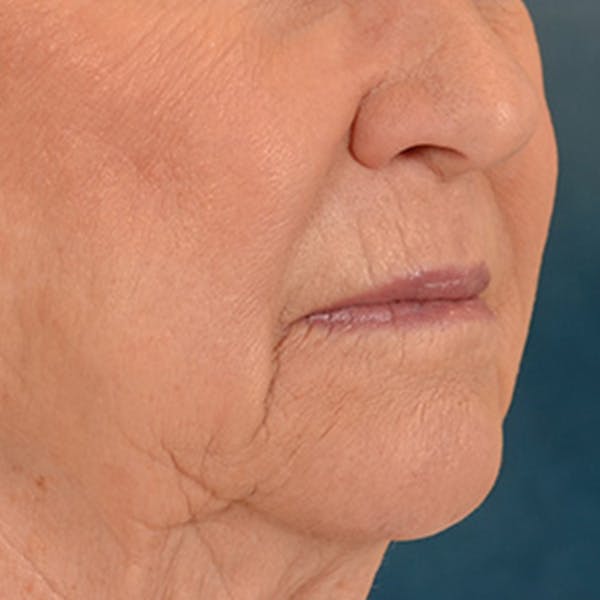 Lip Lift Before & After Gallery - Patient 390400 - Image 3