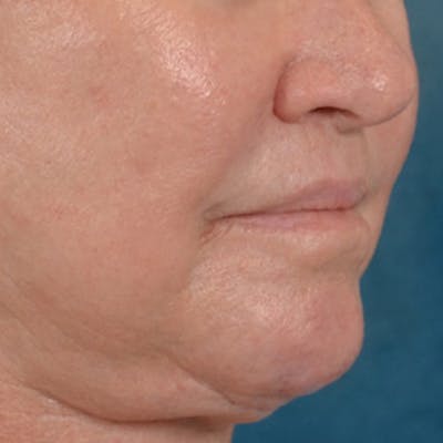 Lip Lift Before & After Gallery - Patient 390400 - Image 4