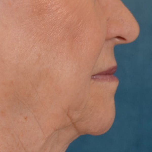 Lip Lift Before & After Gallery - Patient 390400 - Image 5