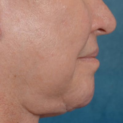 Lip Lift Before & After Gallery - Patient 390400 - Image 6