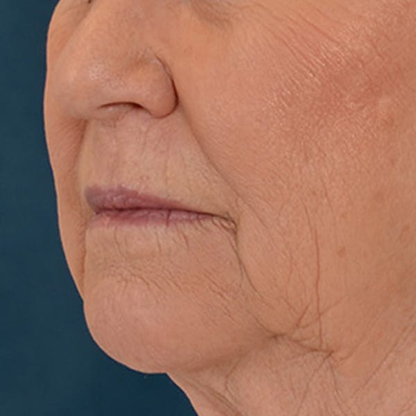 Lip Lift Before & After Gallery - Patient 390400 - Image 7