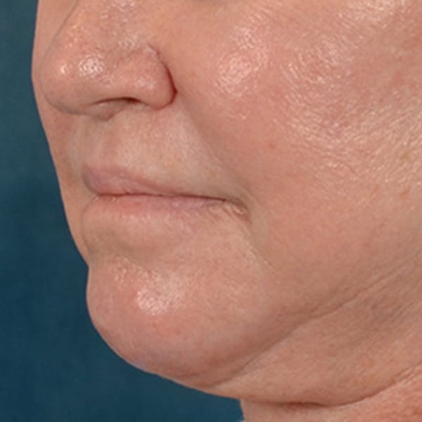 Lip Lift Before & After Gallery - Patient 390400 - Image 8