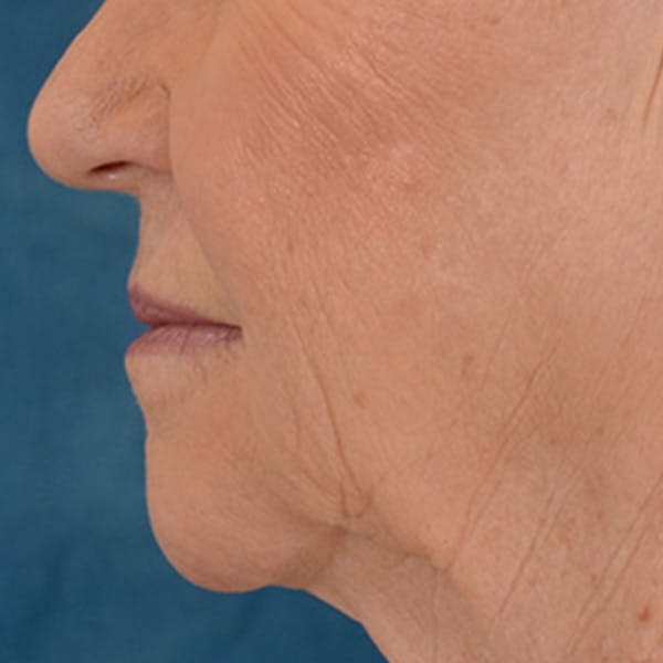 Lip Lift Before & After Gallery - Patient 390400 - Image 9