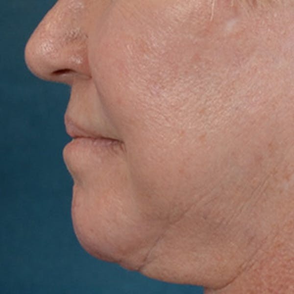 Lip Lift Before & After Gallery - Patient 390400 - Image 10