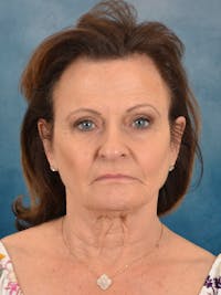 Deep Neck Lift Before & After Gallery - Patient 966989 - Image 1