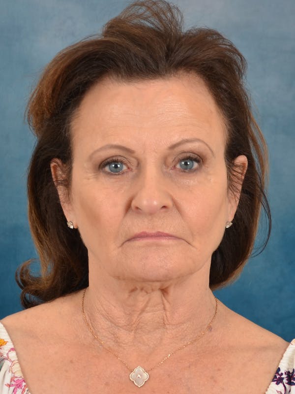 Deep Neck Lift Before & After Gallery - Patient 966989 - Image 1