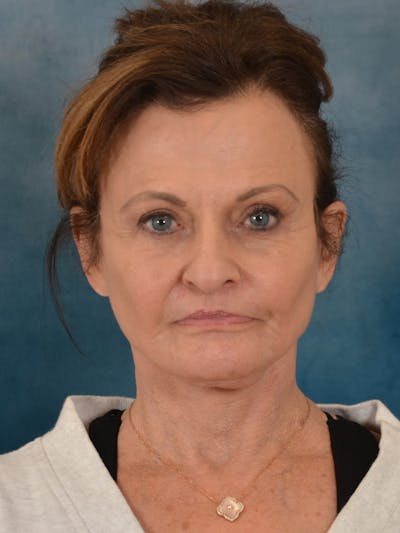 Deep Neck Lift Before & After Gallery - Patient 966989 - Image 2
